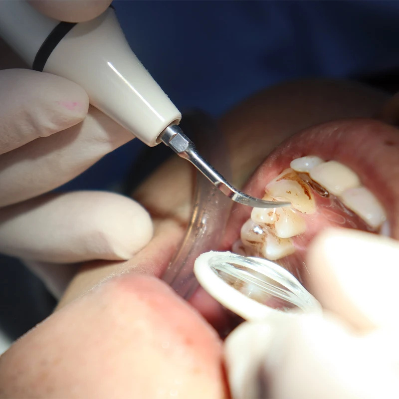 Câble de Tube de pièce à main  - Teeth Whitening Youtube avis et prix