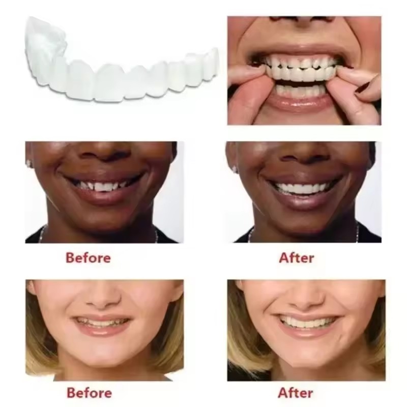 Veneers dentaires blanchissant - Teeth Whitening For Braces avis et prix