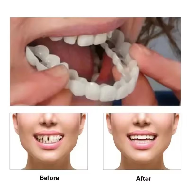 Veneers dentaires blanchissant - Teeth Whitening For Braces avis et prix